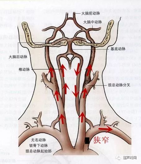 頸部血管彩超報鎖骨下動脈盜血什麼意思