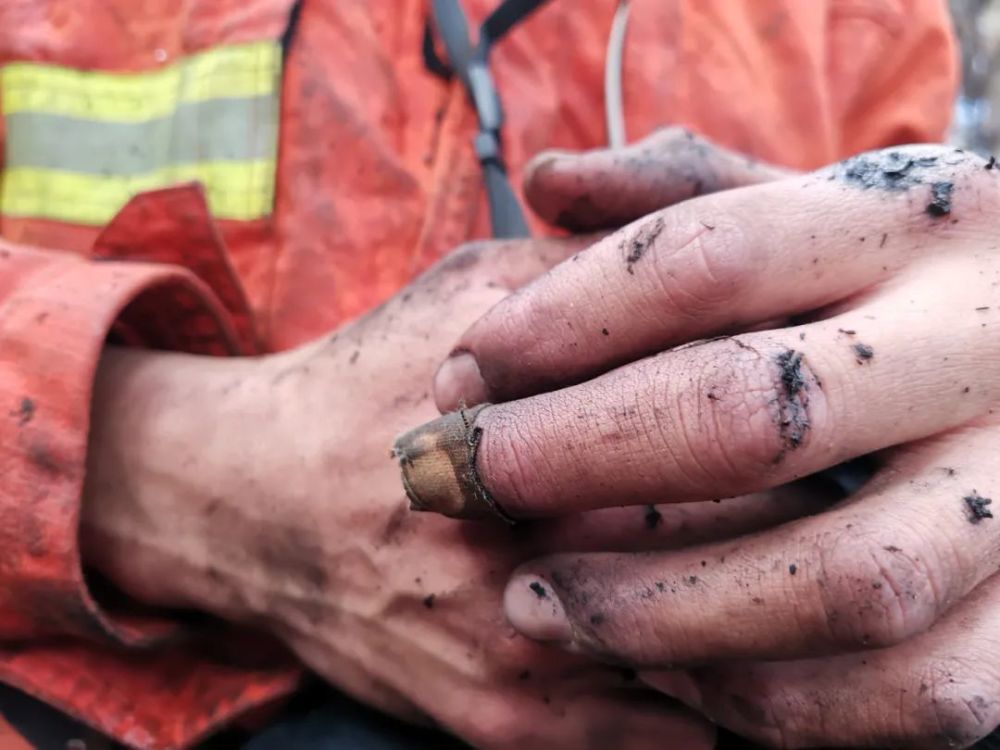 消防兵受伤的手图片