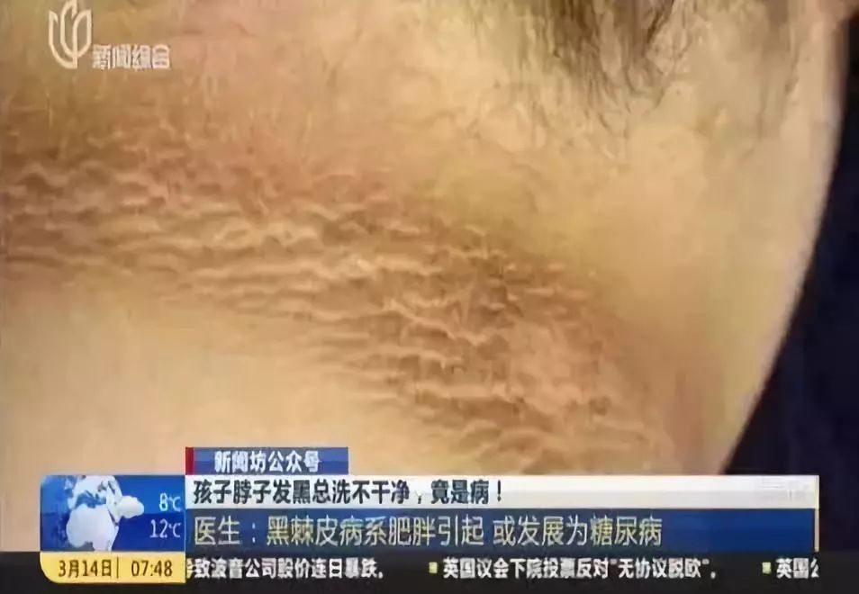 洗不白的"黑脖子"不是脏,而是患了这种病!