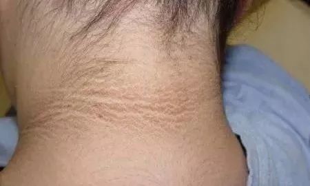 洗不白的黑脖子不是脏而是患了这种病赶紧看看宝宝的脖子
