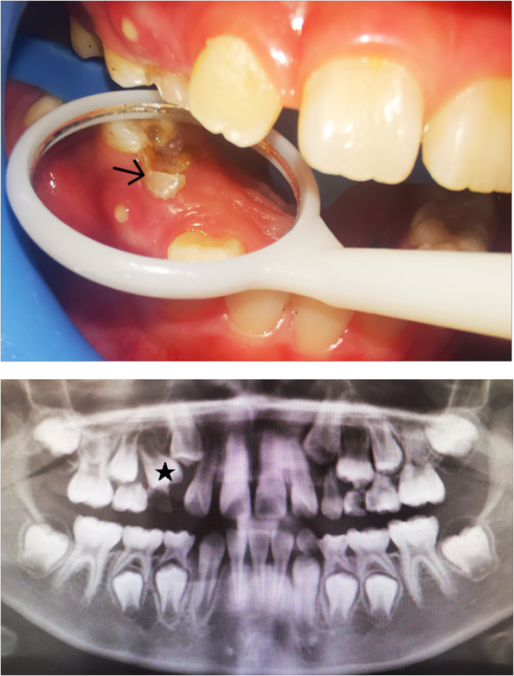 杭州6岁孩子长出双排牙这个错误的育儿习惯许多家长都有