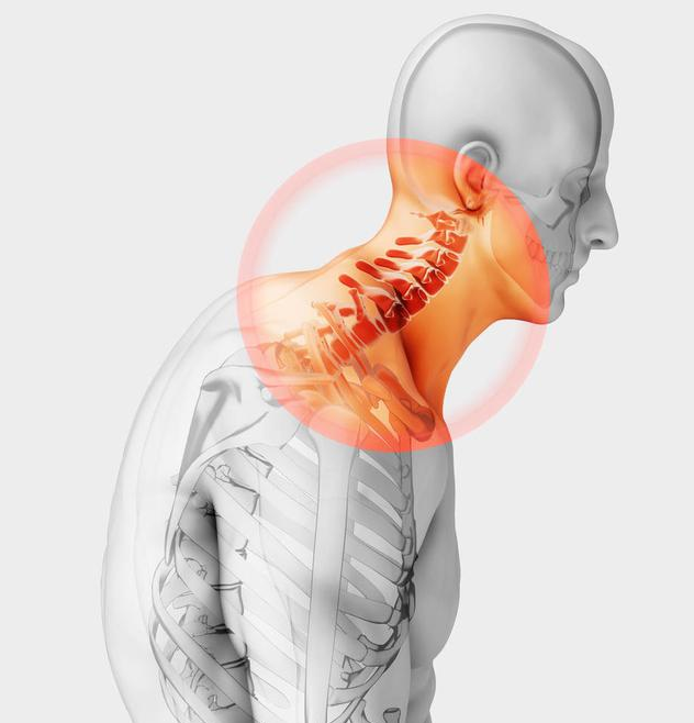 颈椎病|骨科大夫揭秘：全国约1.5亿人患颈椎病 如何对颈椎病说不