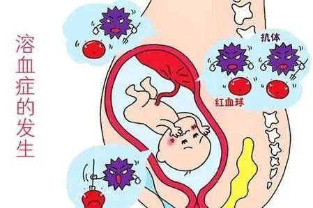 新生儿溶血病|罕见的新生儿溶血病