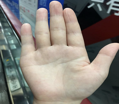 手汗症|治疗手汗也需要勇气！