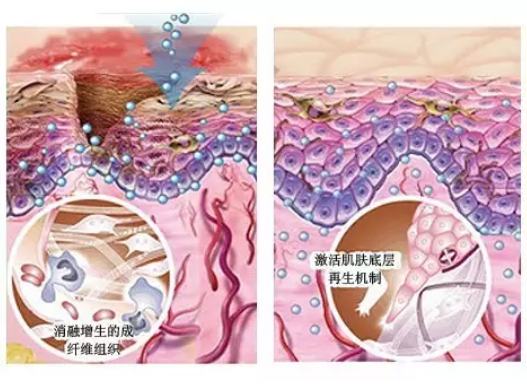 但是,有的求美者到医院做激光祛疤时,医生却遭到医生的劝阻,这到底是