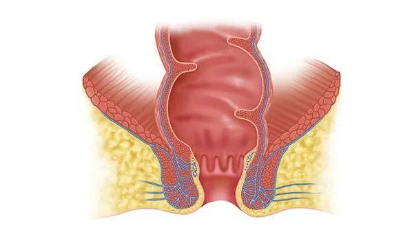 找準病因痔瘡分為內痔,外痔和混合痔瘡三種,患有內痔的患者時常會出現