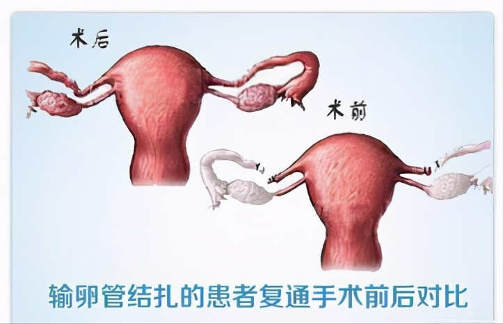 69腹腔镜下输卵管复通,经过正确的调理.