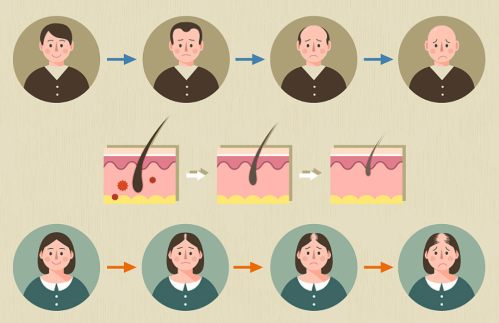 脱发|年纪轻轻的，我为何秃了？