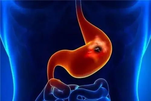 胃炎|十人九胃病，我们如何保护肠胃？