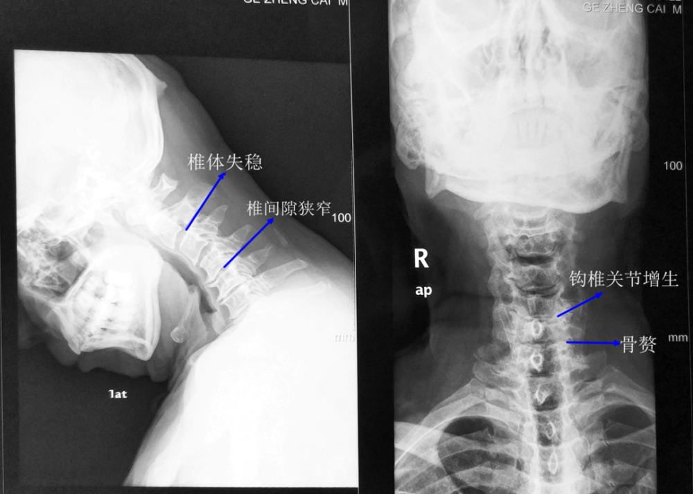 椎间隙狭窄,椎管狭窄,椎体后缘骨赘形成,在颈椎的过伸过屈位片上还