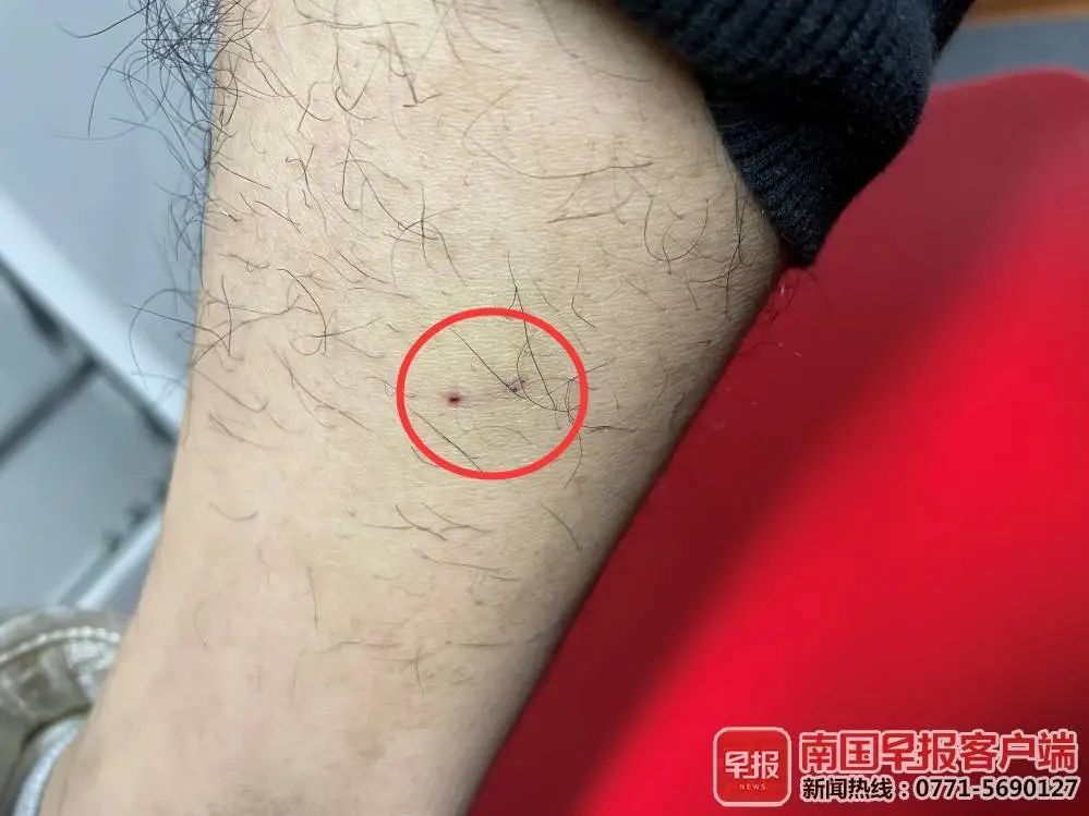 南宁一高考生小区内被狗咬伤狗主人至今未现身警方已介入调查