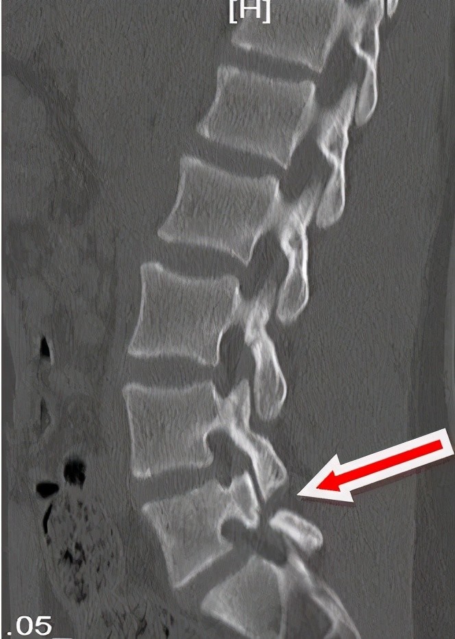 什么是腰椎峡部裂?以便我们正确地掌握及预防它.
