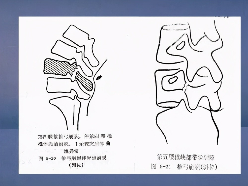 经常腰痛可能是这种疾病发出的信号别不当回事儿