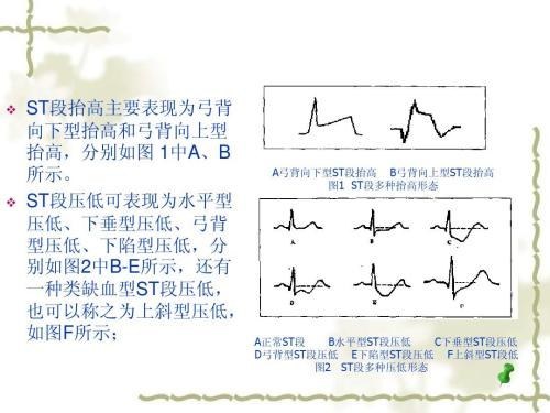 第一,當心電圖q波明顯增寬,並且st段會出現弓背向上抬高,要警惕是急性