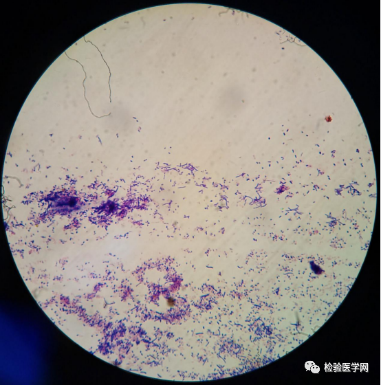 特征不典型抗酸染色弱还能报诺卡菌吗