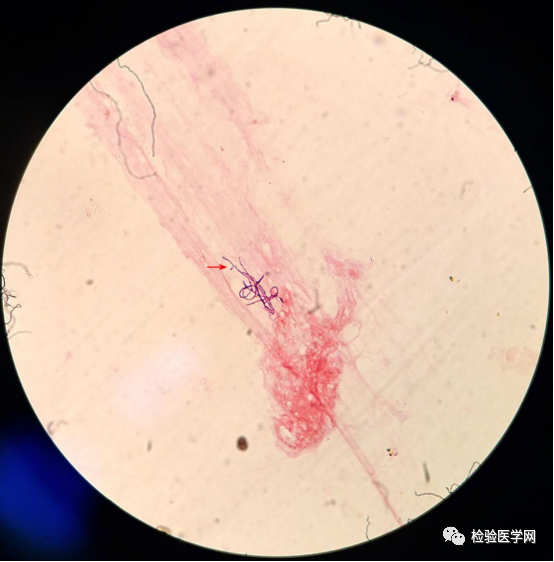 特征不典型 抗酸染色弱 还能报诺卡菌吗 腾讯新闻