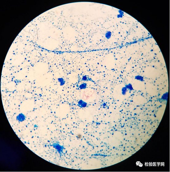 上圖對樣本用珠海貝索普通抗酸染液脫色120秒發現的一處絲狀菌(10*100