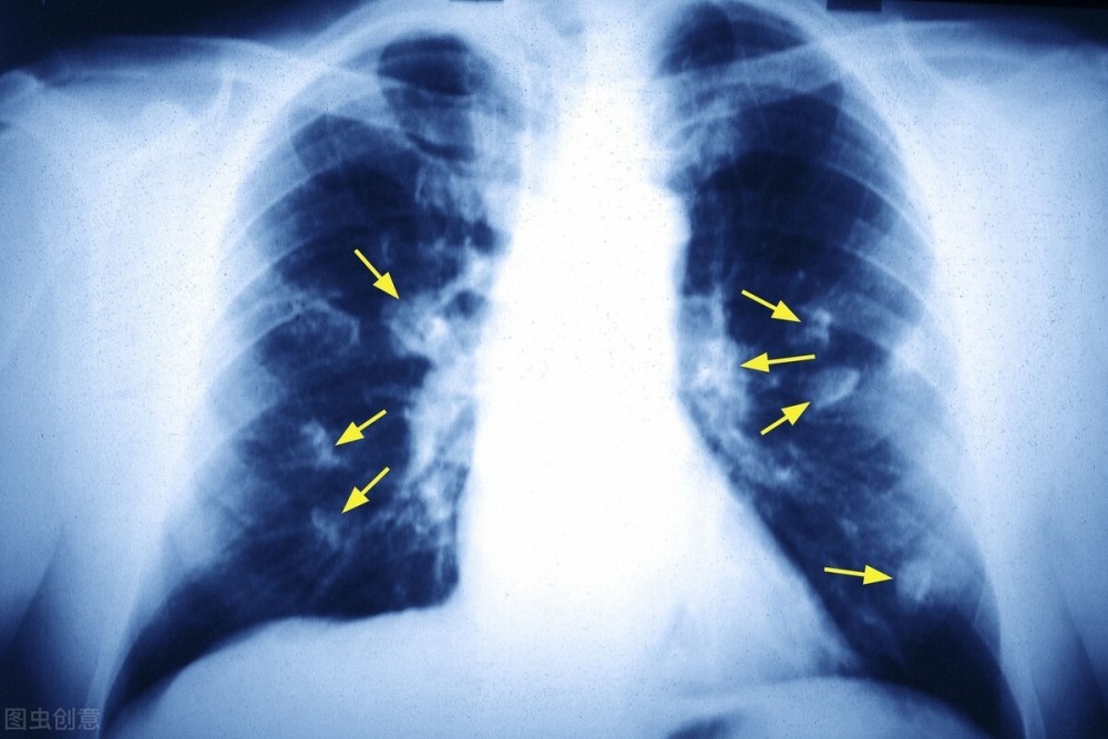吸烟的肺部x光片图片