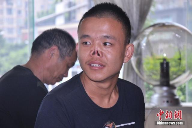 李明渴望有一个鼻子,渴望有一个正常人的生活.