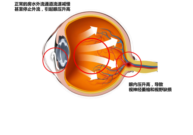 得了青光眼自己就能好吗