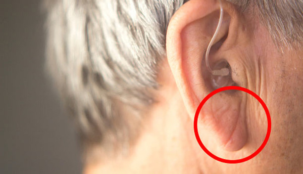 耳垂褶皱症图片