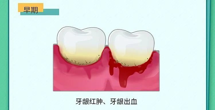 牙周炎一個由牙菌斑引起的牙病