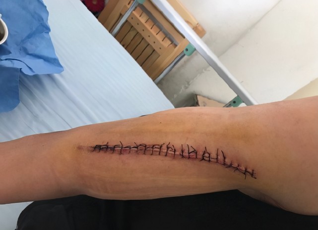 是亚洲冠军曾重伤缝66针12颗钢钉不放弃篮球来自山东