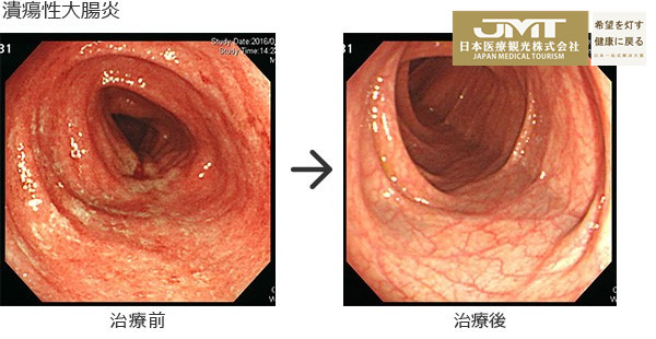 溃疡性大肠炎|JMT日本疑难病治疗-溃疡性大肠炎通过适当治疗可以恢复到健康人状态