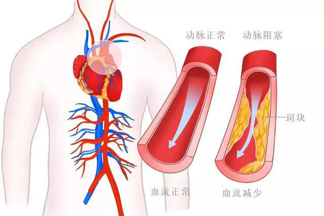 冠心病|得了冠心病严重吗？冠心病能治好吗？做到2点，延年益寿也不难