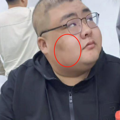 泡泡龙去世后,又有一位大胃王脸上出现黑斑,网友:没事食材健康