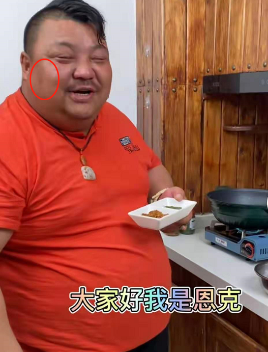 泡泡龍去世後,又有一位大胃王臉上出現黑斑,網友:沒事食材健康