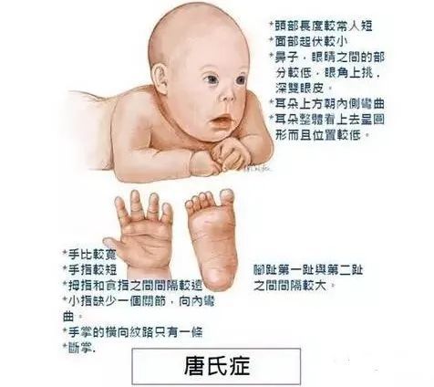 世界唐氏综合征日|什么是唐氏综合征?怎样筛查预防?_腾讯新闻