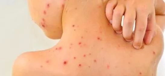 水痘是种可怕的病吗