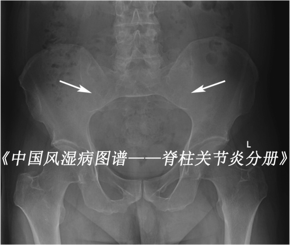 强直性脊柱炎患者,图为x线片示骶髂关节炎Ⅳ级(箭头处.