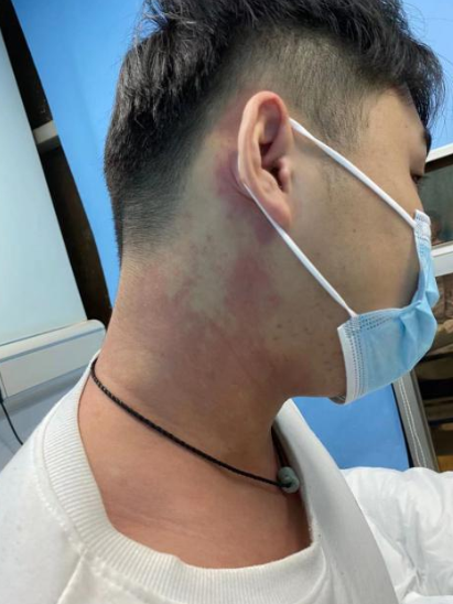 贪吃甲鱼,年轻小伙过敏致呼吸困难险丧命