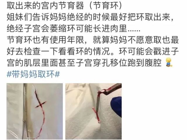 带妈妈去取节育环