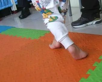 痉挛性截瘫的病因脑瘫也能治