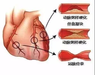 冠心病多發於40歲以上成人,男性發病早於女性,高膽固醇血癥,高血壓病