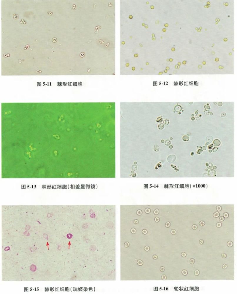 一文读懂尿液红细胞形态分析