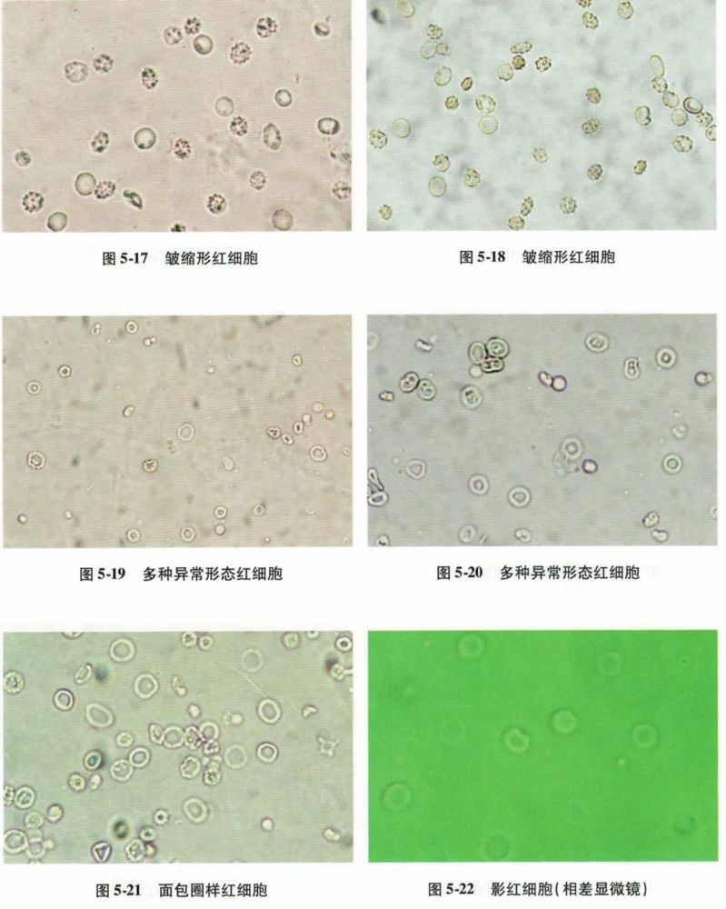 一文读懂尿液红细胞形态分析