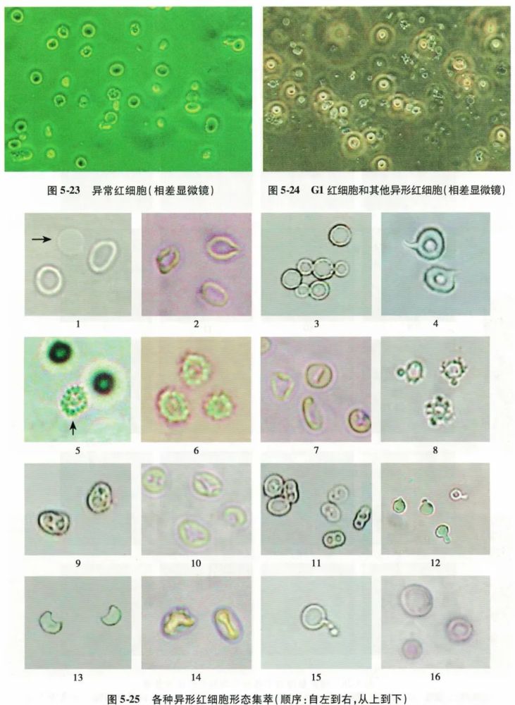一文读懂尿液红细胞形态分析