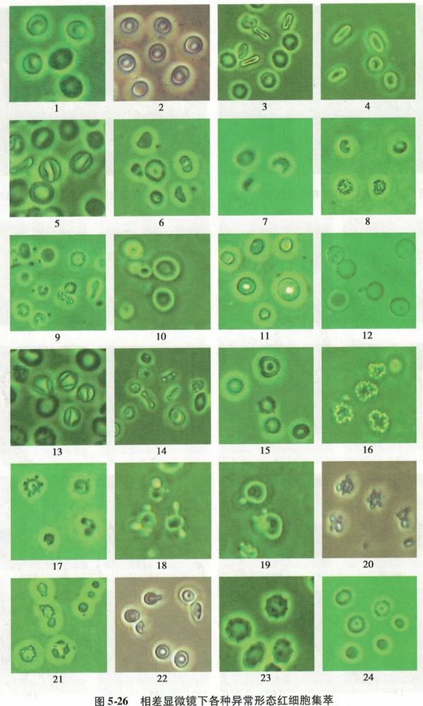 一文读懂尿液红细胞形态分析