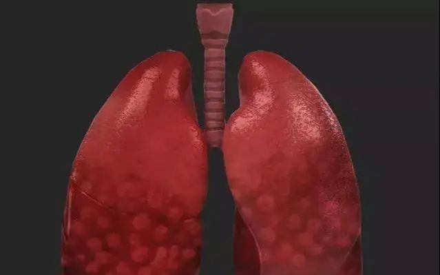 肺部|肺不好，会出现“1粗、2痛、3多”，占一个，也最好去查肺CT