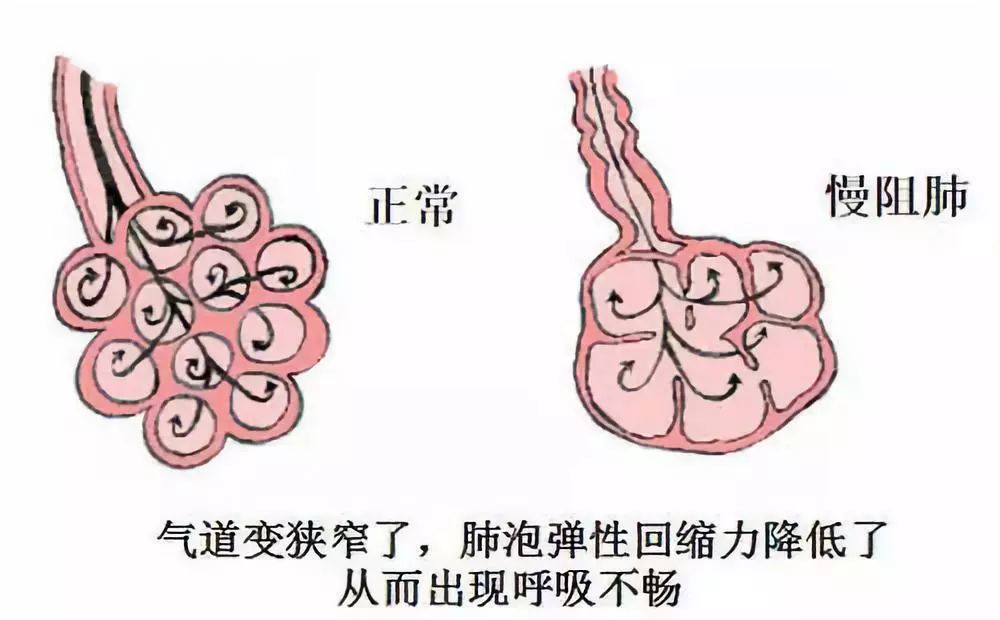 什麼叫慢阻肺都有什麼症狀