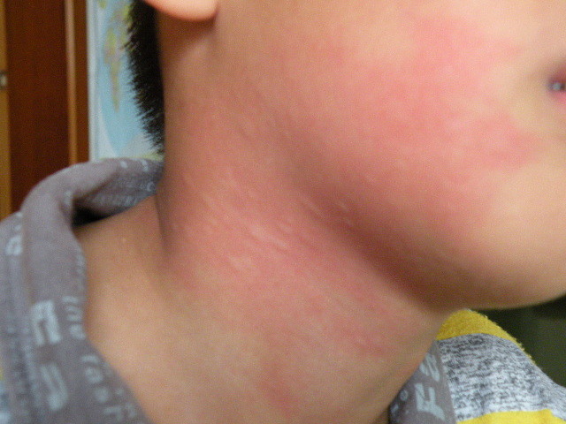 通常来说,儿童皮肤病是一种非常常见的儿童疾病,它的种类很多,如水痘