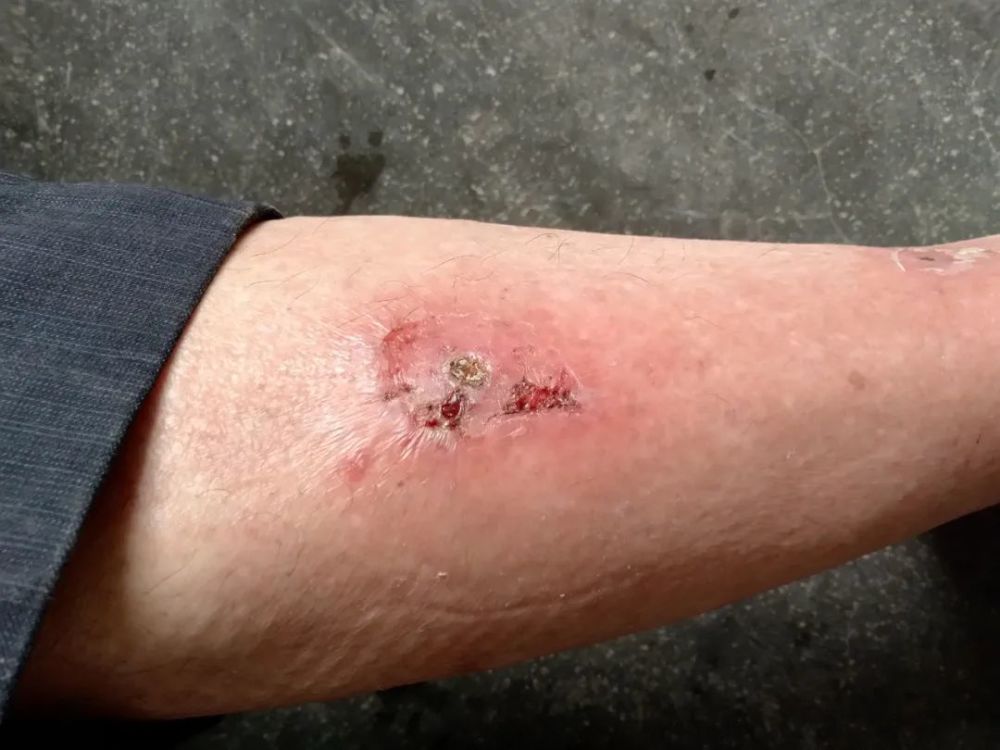 在一坡地进行除草工作时被红火蚁咬伤!