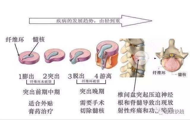 二,主要症状一,腰部疼痛大多数腰椎间盘突出的患者都有腰痛,有些病人