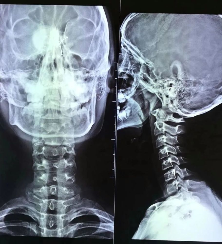 第三,选择适合自己的枕头和床垫,让脖子有良好的支撑,颈椎不悬空.