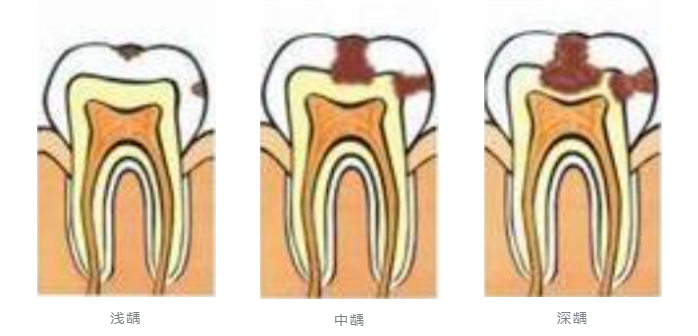 浅龋中龋深龋儿童大概在两岁半的时候长齐乳牙,12岁左右乳牙基本会