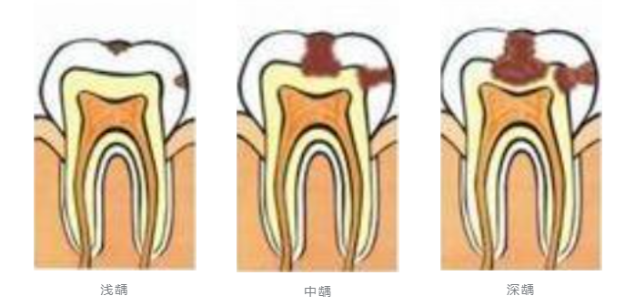 淺齲中齲深齲兒童大概在兩歲半的時候長齊乳牙,12歲左右乳牙基本會